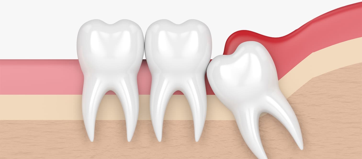 What are wisdom teeth?